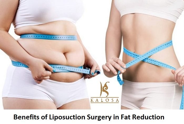 Liposuction Surgery In Fat Reduction