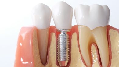 cost of dental implants