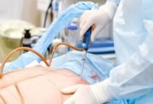 Recovery From Liposuction